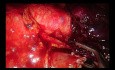 Uniportal VATS Left Upper Lobectomy Blocked by Calcified Lymph Nodes