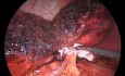 Laparoscopic Radiofrequency Liver Resection for Adenoma