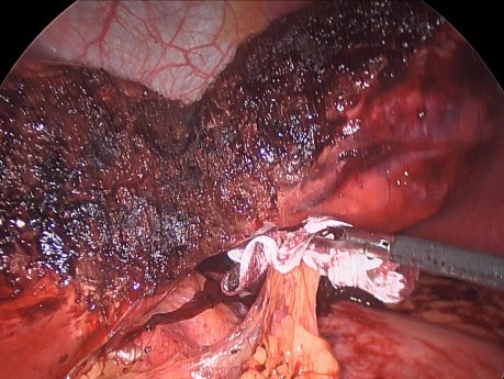 Laparoscopic Radiofrequency Liver Resection for Adenoma