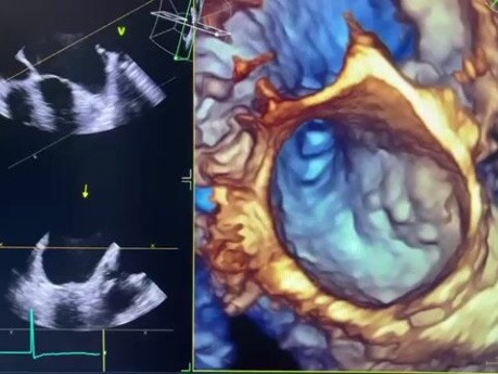 Left Atrial Appendage by 3D TEE