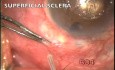 Pseudophakic glaucoma treatment with microtrack filtration