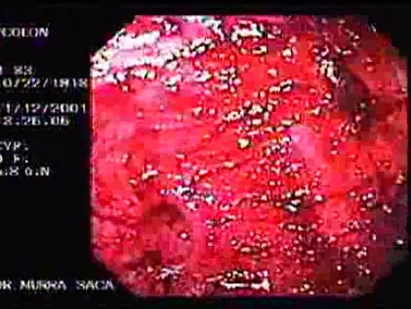 Diverticular Disease - Hemorrhage (4 of 15)