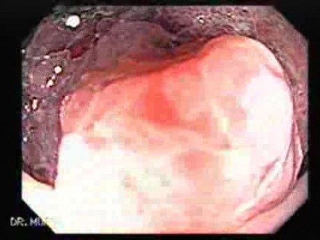 Rectal Adenocarcinoma - Colonoscopy (8 of 8)