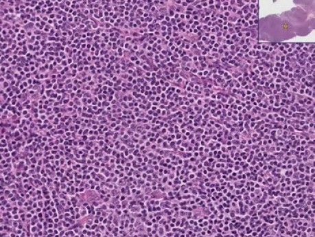 Extranodal marginal zone B-ce - Histopathology  - Salivary gland