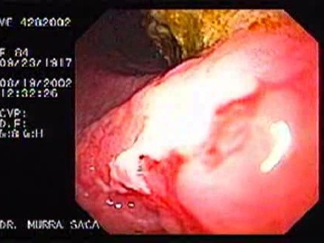Ulcerative Pre - Pyloric Adenocarcinoma - Signet Ring Cells