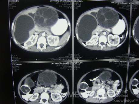 Right and left liver hydatid cyst - Abdominal CT