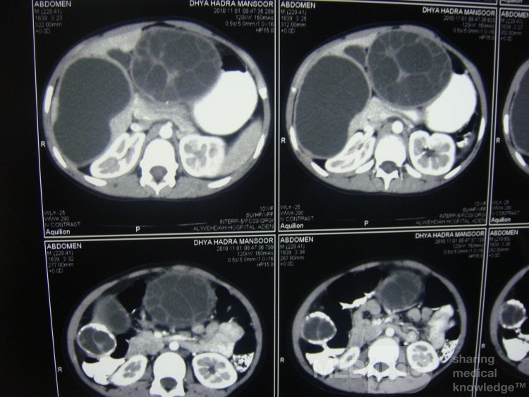 Right and left liver hydatid cyst - Abdominal CT
