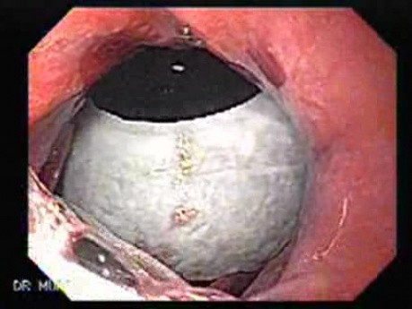 Intragastric Balloon - The Treatment Of Obesity (9 of 13)