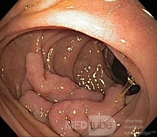 Duodenal Tubulovillous Adenoma