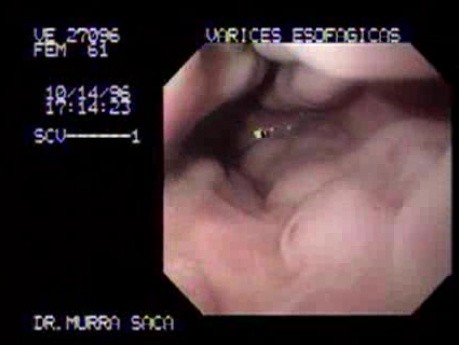 Esophageal Varices - Endoscopic Image - 61 Years-Old Woman
