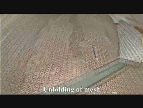 Laparoscopic Umbilical Hernia Mesh Repair (IPOM Plus)