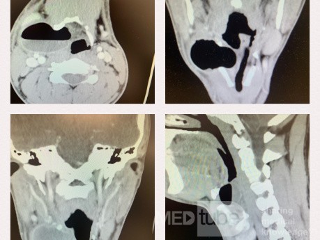 CT Neck with Contrast Showed Rt Mixed Infected (Air -Fluid Level) Laryngocele