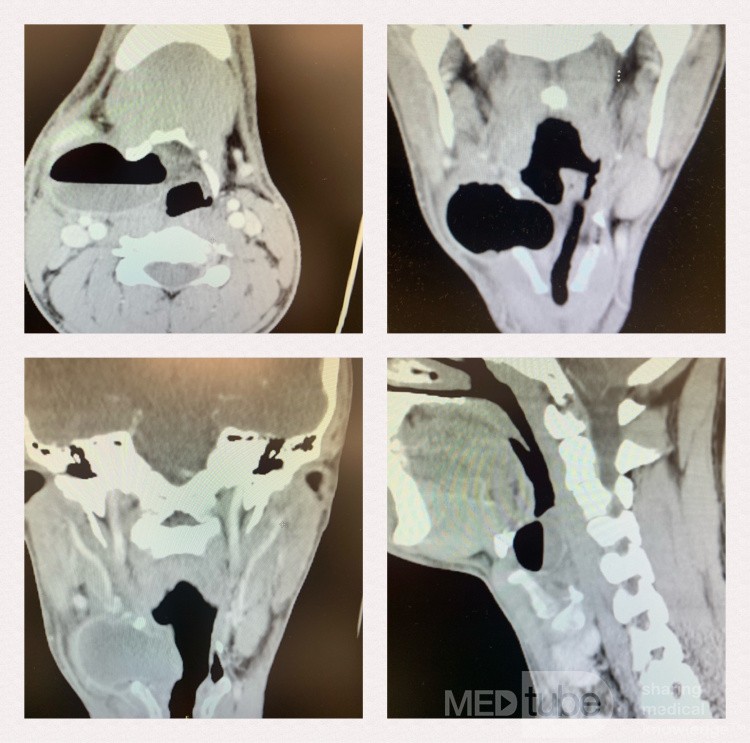 CT Neck with Contrast Showed Rt Mixed Infected (Air -Fluid Level) Laryngocele