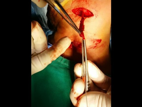 Branchial Fistula Surgery Two Step Incision