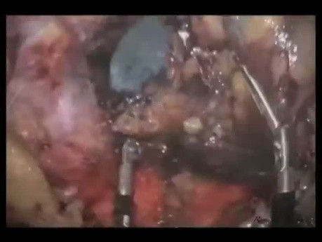 LESS Distal Pancreatectomy and Splenectomy