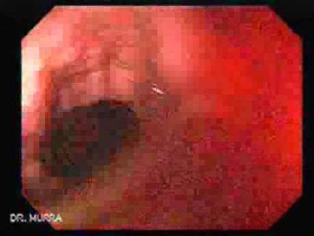Massive Rectal Bleeding (4 of 11)