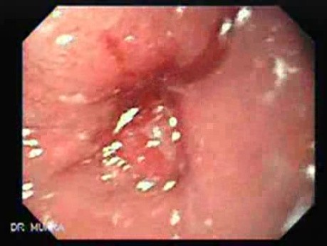 Adenocarcinoma of the Middle Third of Esophagus - Closer Look at the Tumor