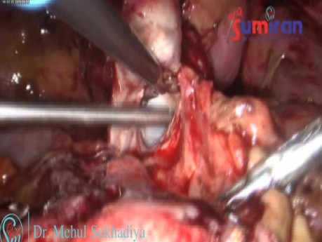 Rudimentary Horn/ Endometriosis / Chocolate Cyst