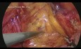 Minimally Invasive Mesh Fixation in a Laparoscopic Inguinal Hernia Repair - a Didactic Video