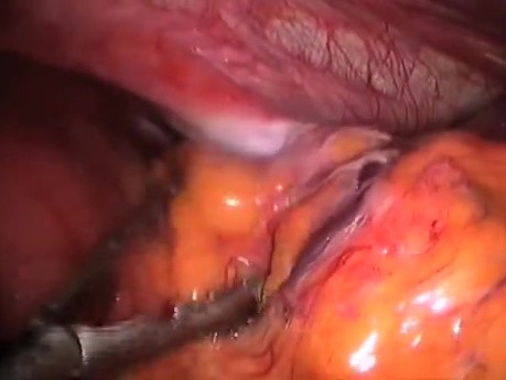 Hiatal Hernia Laparoscopic Correction After Esophagus Excision