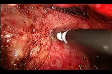 Injury Of Superior Mesenteric Vein During Laparoscopic Pancreatectomy
