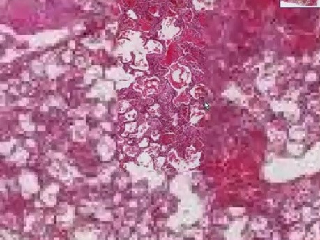 Goodpasture syndrome, pulmonary hemorrh