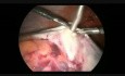 Laparoscopic Management of Huge Ovarian Mass