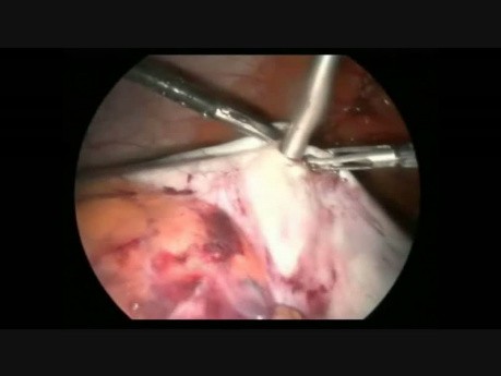Laparoscopic Management of Huge Ovarian Mass