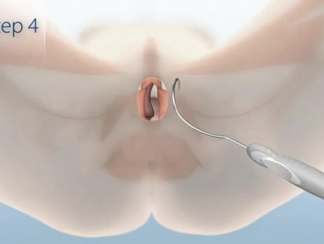 Male Sling System