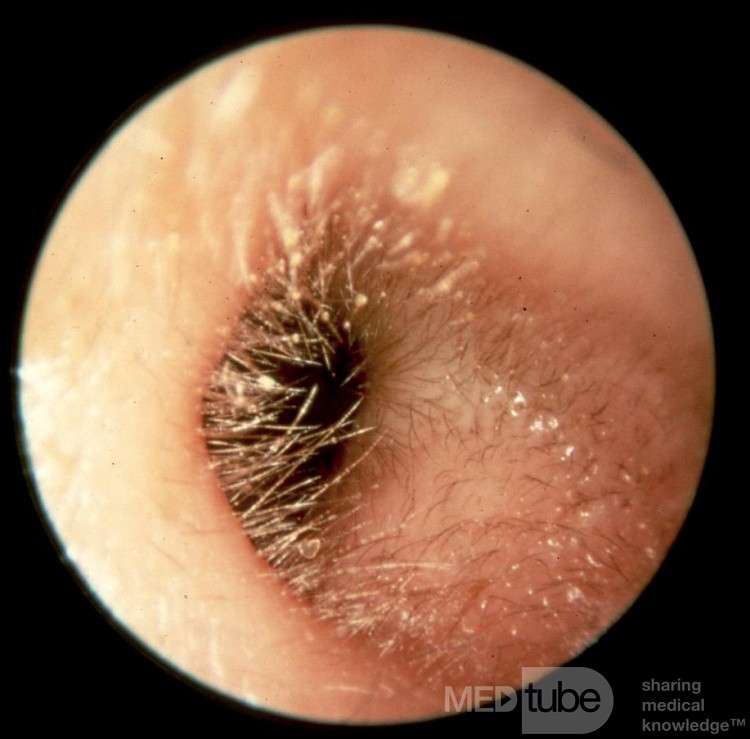 The Cartilaginous External Auditory Canal