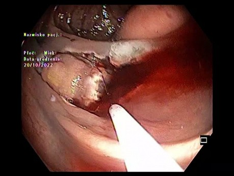 Hybrid ESD/EMR with Semicircumferential Incision, Bleeding and Clips in Ascending Colon