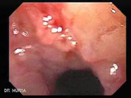 Esophageal Squamous Cell Carcinoma - Presentation of Neoplastic Lesion with Ulceration and Bleeding