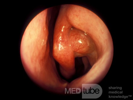 Polyp Arising from the Frontal Recess