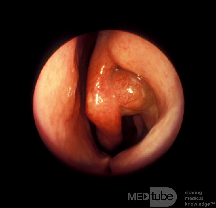 Polyp Arising from the Frontal Recess