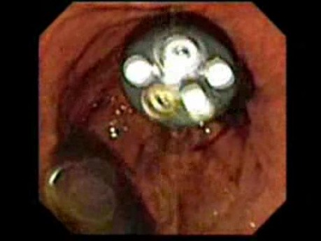 View Of The Endoscope Introduced Classically - Camera Of Endoscope In The Gastrostomy