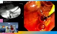 ERCP for Neoplastic Lower CBD Stricture