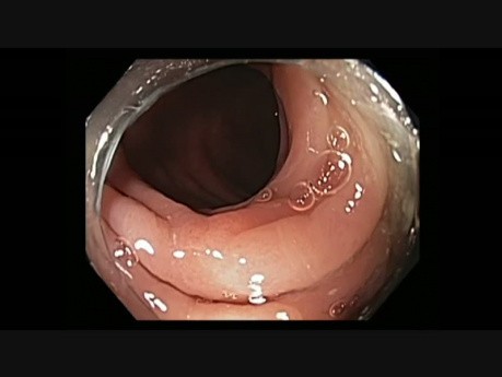 Colonoscopy - Multiple Subtle Flat Lesions - EMR + Hot Biopsy Avulsion
