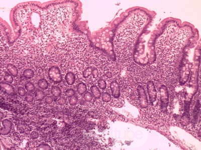 Gastric lymphoma with metastases to the duodenum (15 of 15)