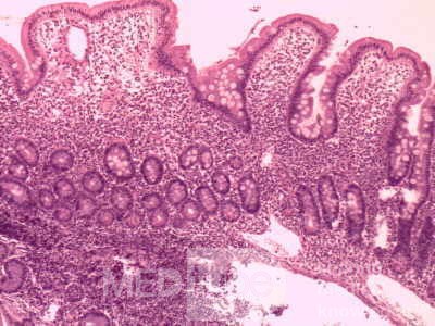 Gastric lymphoma with metastases to the duodenum (15 of 15)