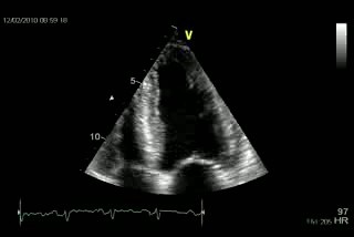 Longitudinal Left Ventriculi Dysfunction Cardiac Amyoidosis