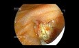 Ampullectomy - Obstructive Jaundice