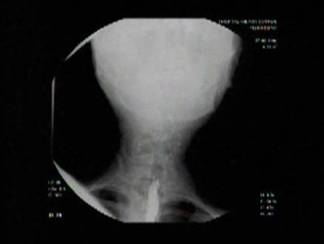 Esophageal Achalasia - Barium Swallow