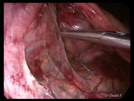 Laparoscopic Ileo-cecal Resection the Total Retro-mesenteric Approach