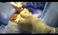 Male Rhinoplasty for Droopy and Crooked Nose 