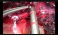Unisurgeon Uniportal VATS Anatomic Segmentectomy S3
