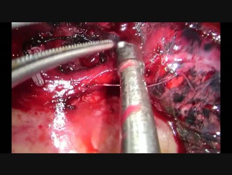 Unisurgeon Uniportal VATS Anatomic Segmentectomy S3