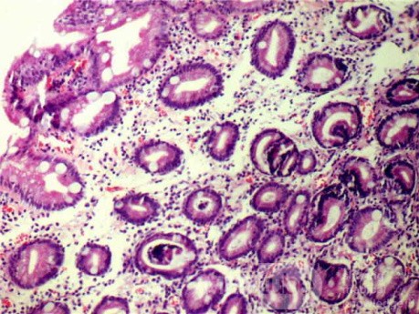 Intestinal Metaplasia (5 of 5)