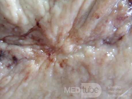 Small Gastric Adenocarcinoma of the Diffuse Ring Cell (17 of 19)