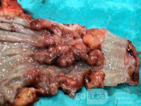 Barrett Adenocarcinoma - Endoscopic Image (20 of 20)