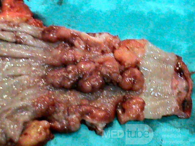Barrett Adenocarcinoma - Endoscopic Image (20 of 20)